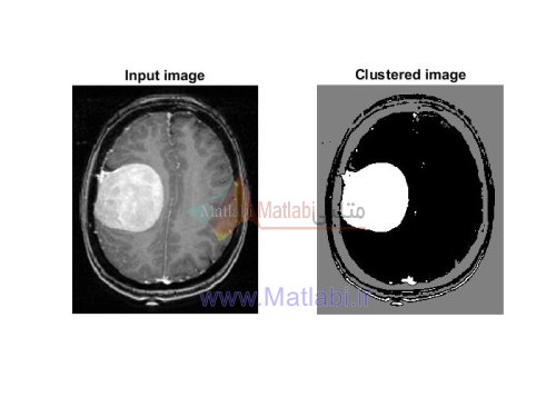 Improved fuzzy clustering approach Application to medical image MRI