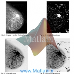 Mammogram Breast Cancer Image Detection Using Image Processing Functions